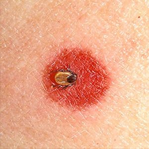 tick disease